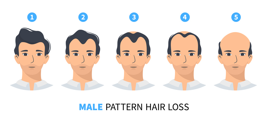 Androgenetic Alopecia Simplified and Demystified