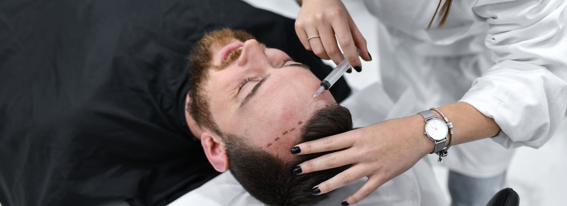 Body Hair Transplant