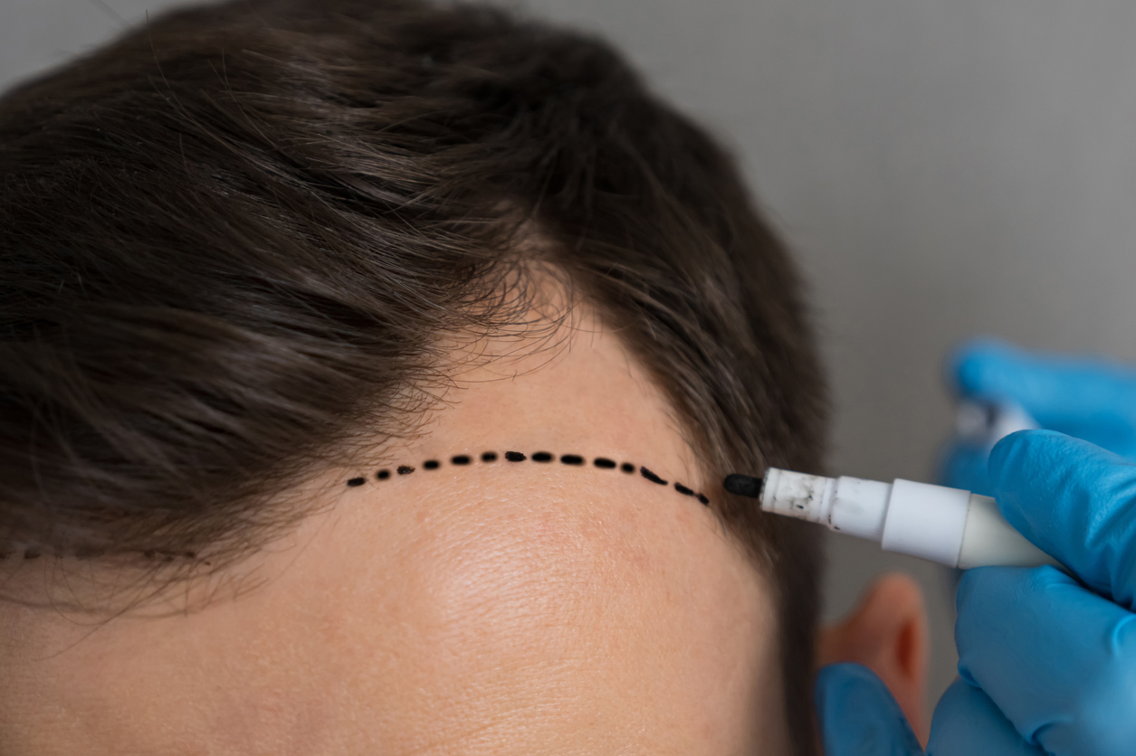 Choosing the Right Hairline Design for Male Hair Transplant