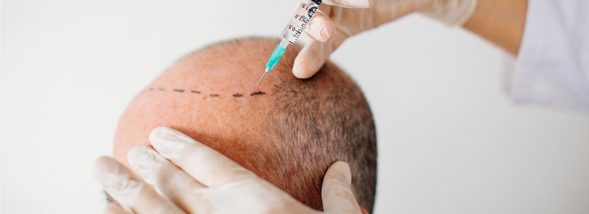 crown-hair-transplant-surgery