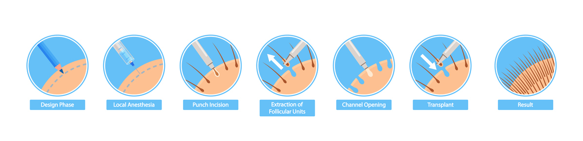 The Benefits of Follicular Unit Extraction (FUE) in Hair Transplants