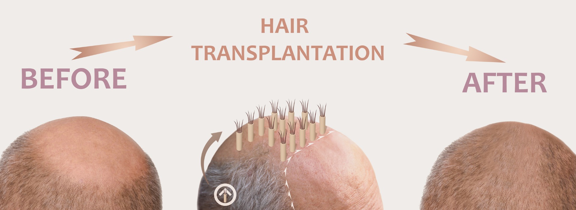 fue-follicular-unit-extraction-hair-transplant