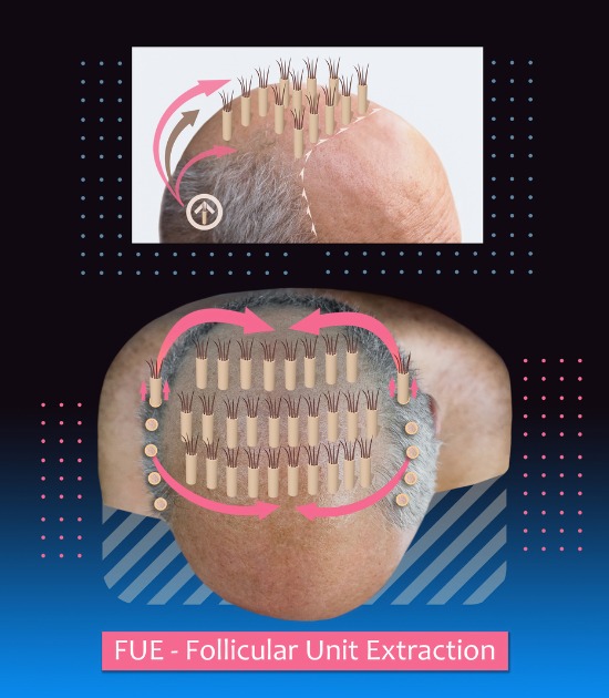 fue-follicular-unit-extraction-procedure