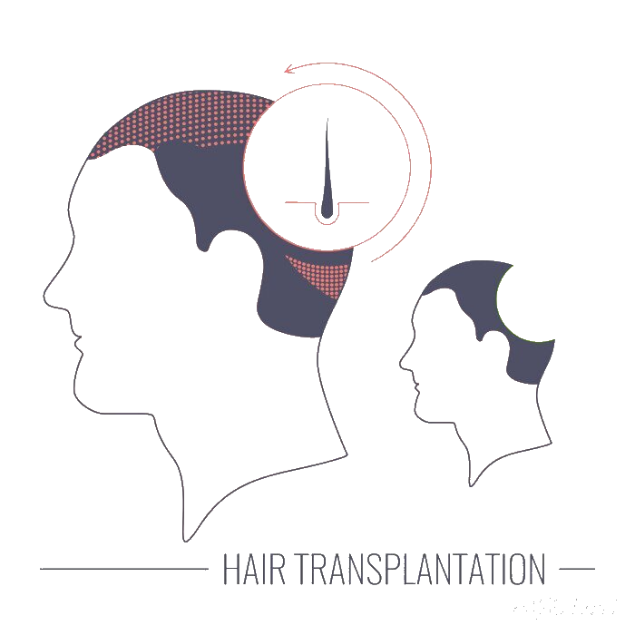 Hair Transplant Correction