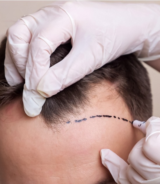hair-transplant-correction-procedure