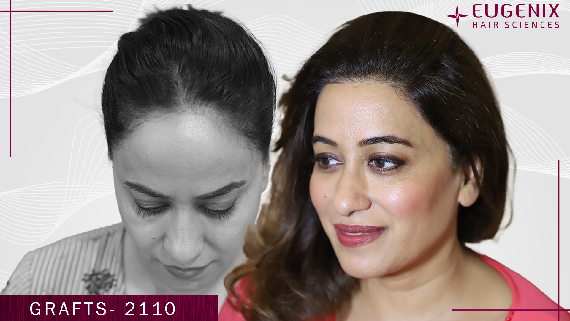 hair-transplant-for-women-before-and-after-uk-1