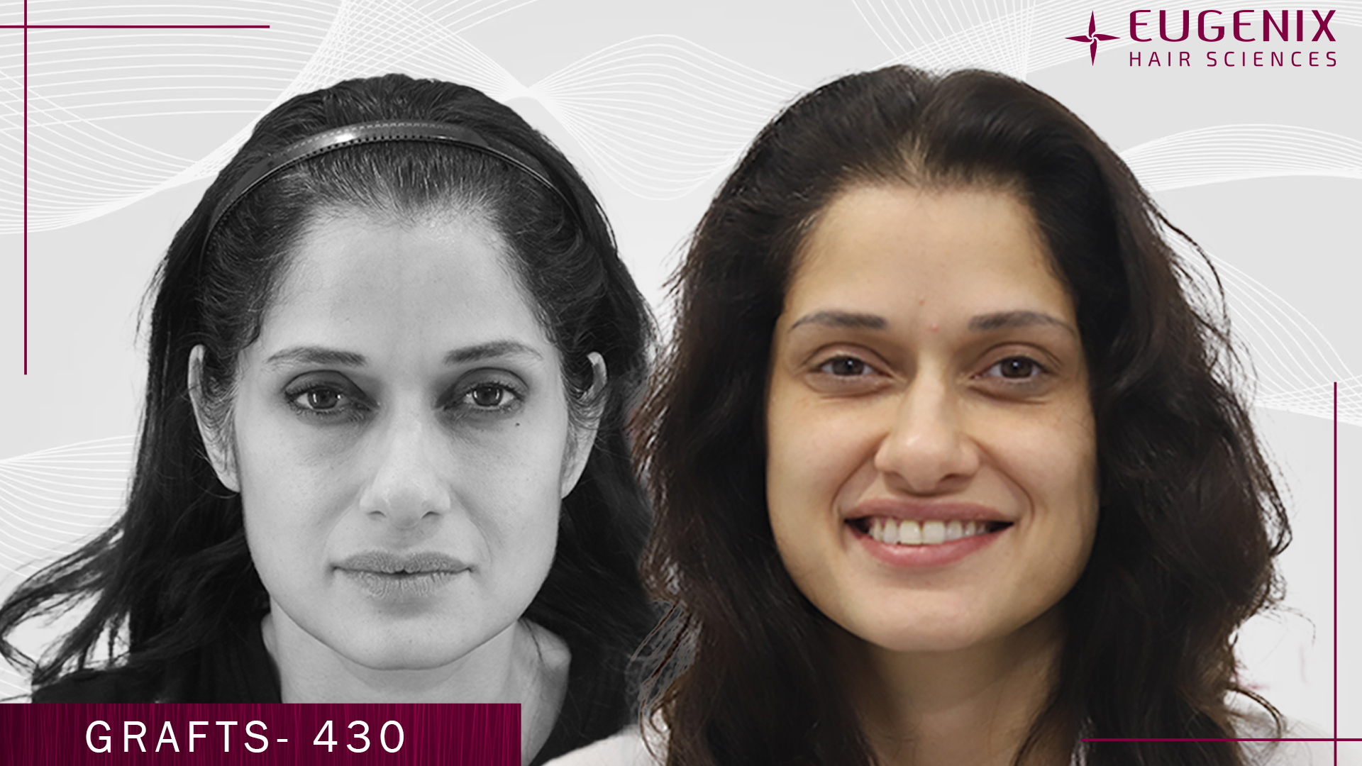 hair-transplant-for-women-before-and-after-uk-2