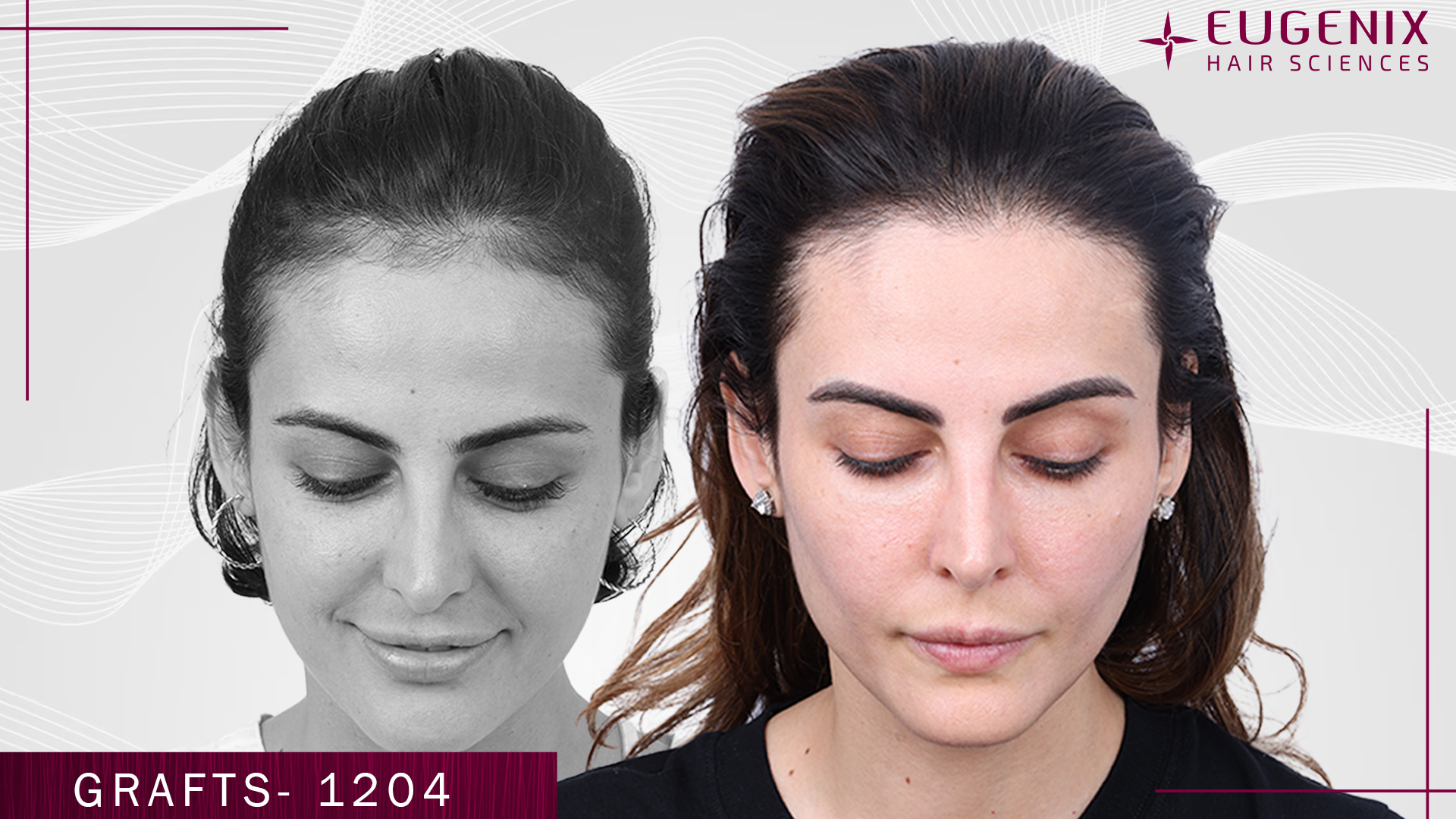 hair-transplant-for-women-before-and-after-uk-3