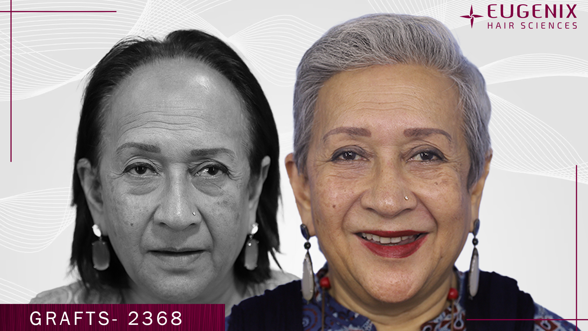 hair-transplant-for-women-before-and-after-uk-4