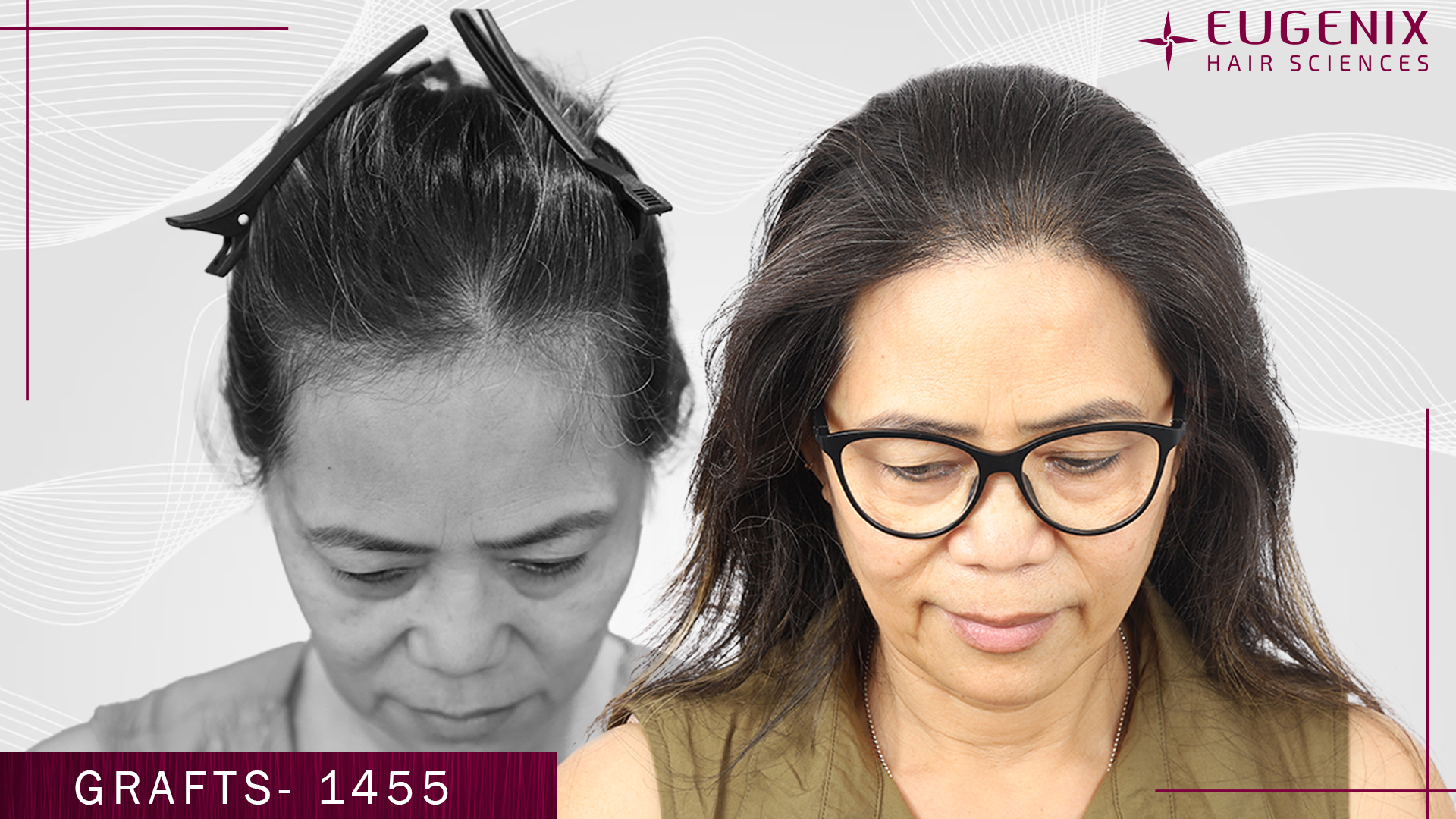 hair-transplant-for-women-before-and-after-uk-5