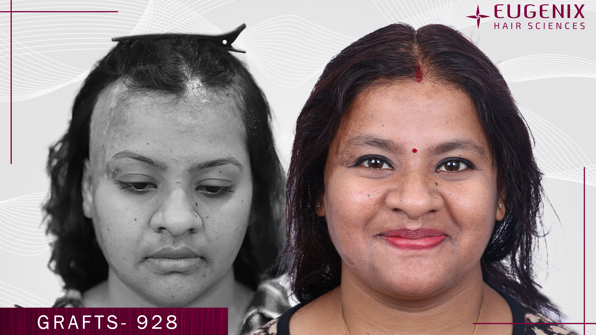 hair-transplant-for-women-before-and-after-uk-6