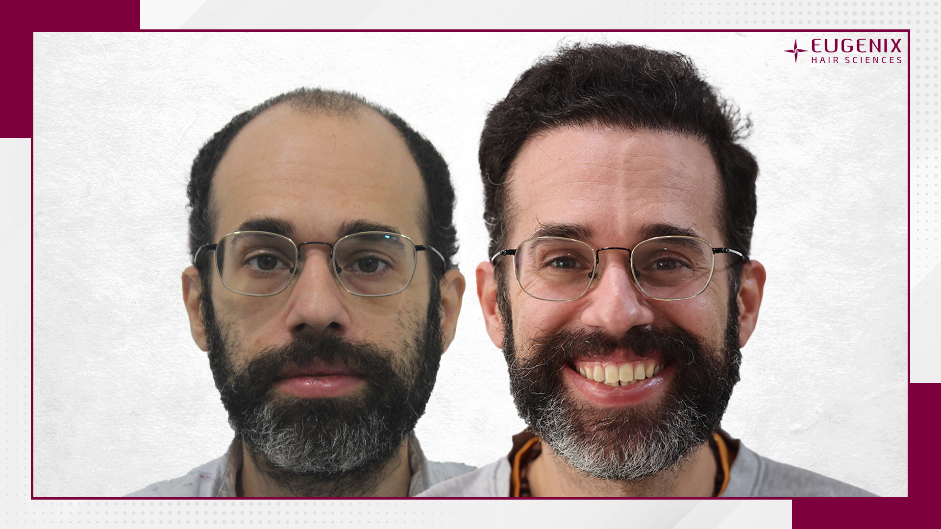 male-hair-transplant-before-and-after-uk-11