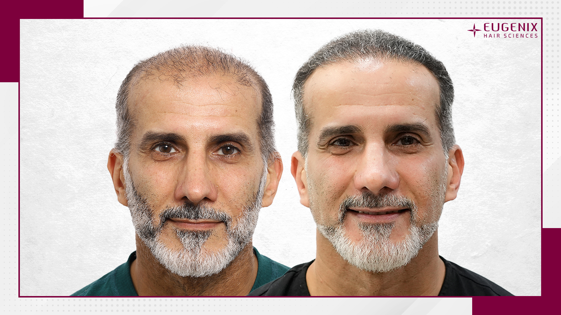 male-hair-transplant-before-and-after-uk-2