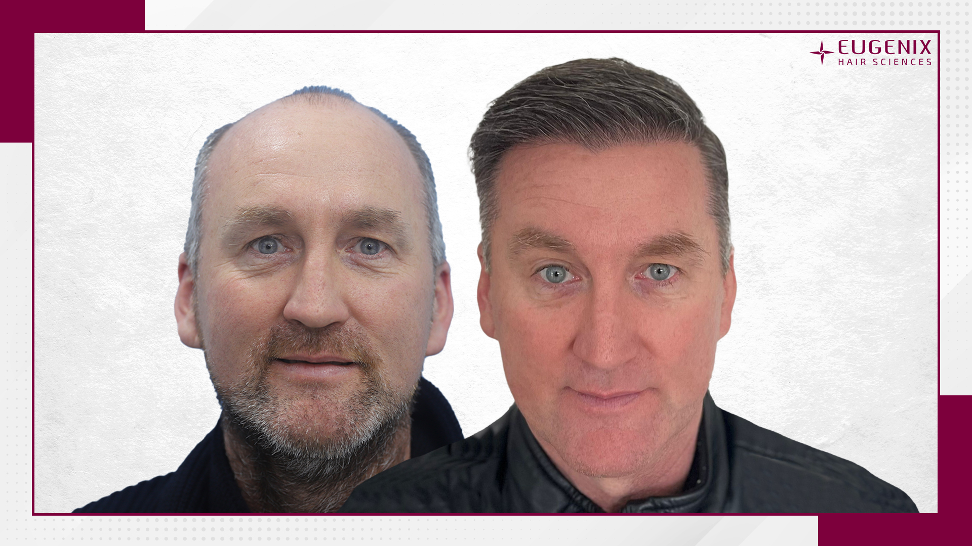male-hair-transplant-before-and-after-uk-3
