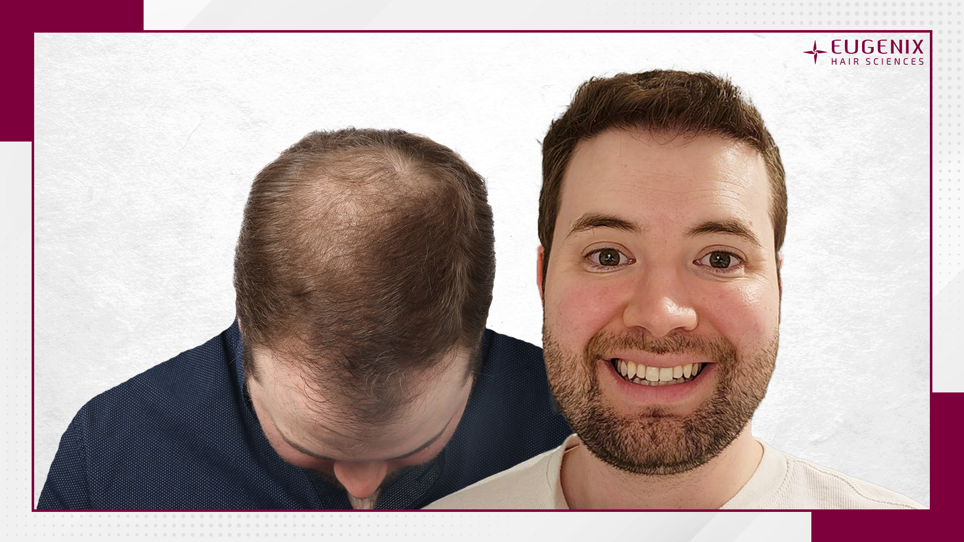 male-hair-transplant-before-and-after-uk-4