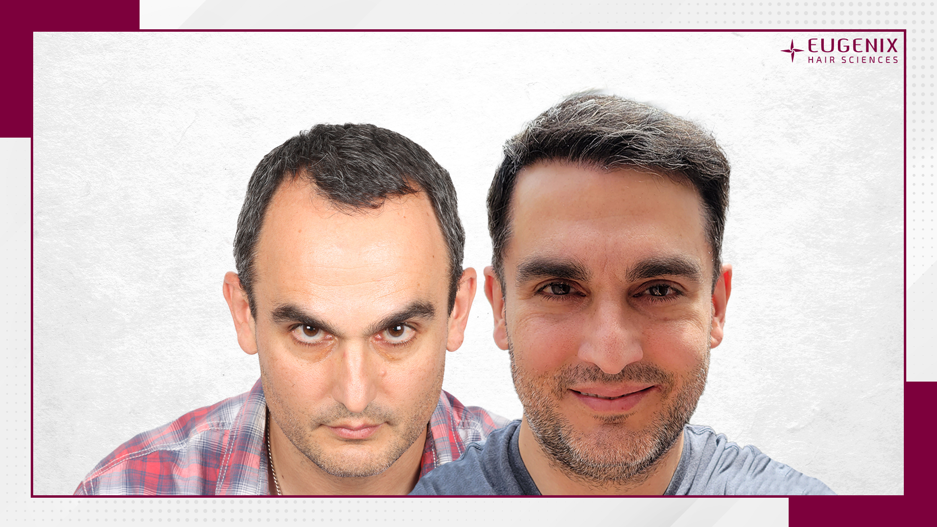 male-hair-transplant-before-and-after-uk-6