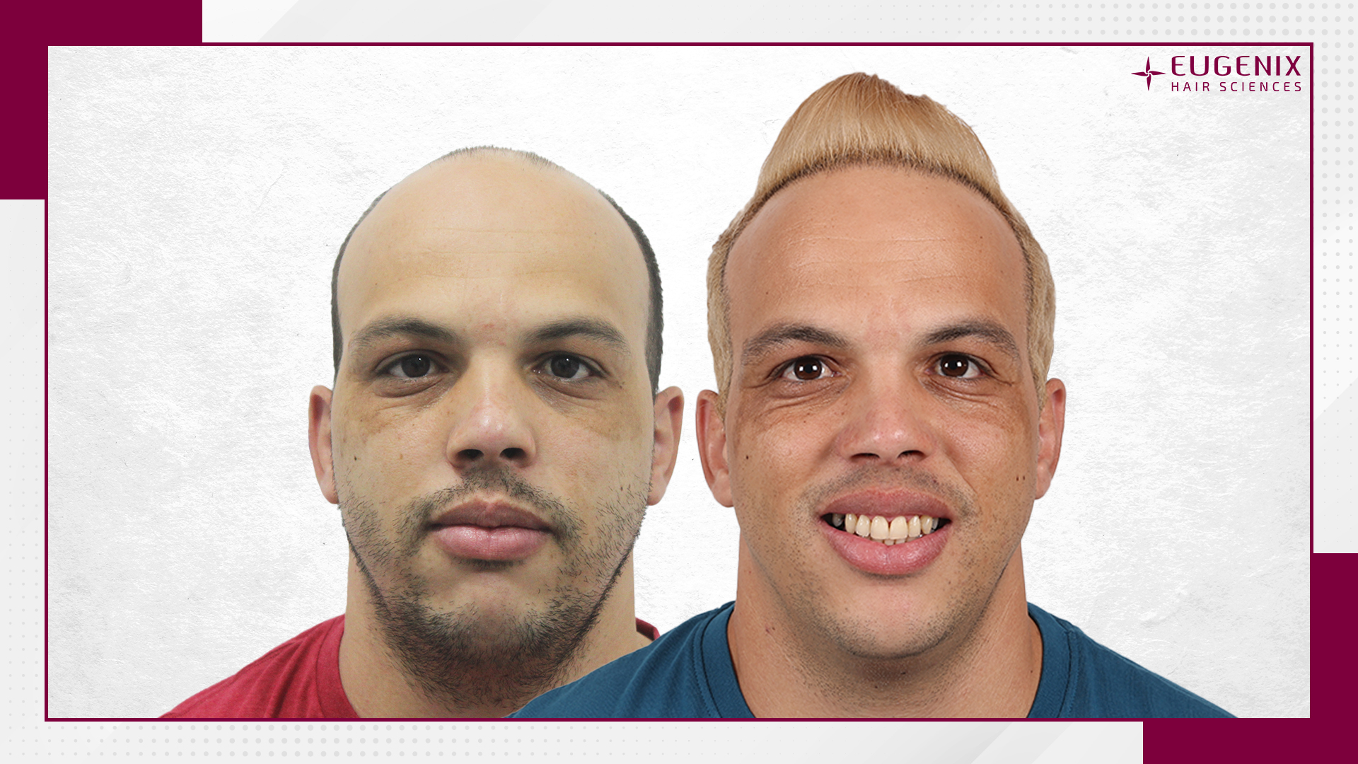 male-hair-transplant-before-and-after-uk-7
