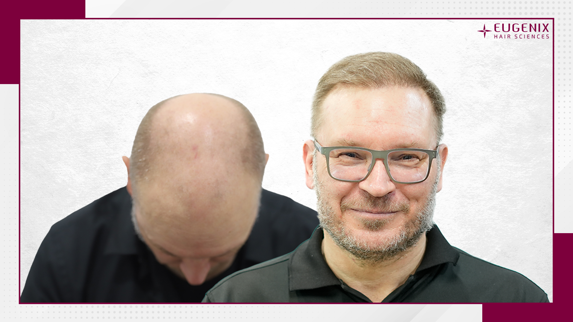 male-hair-transplant-before-and-after-uk-8