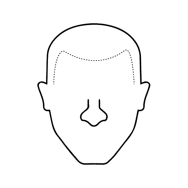 Receding Hairline Reconstruction