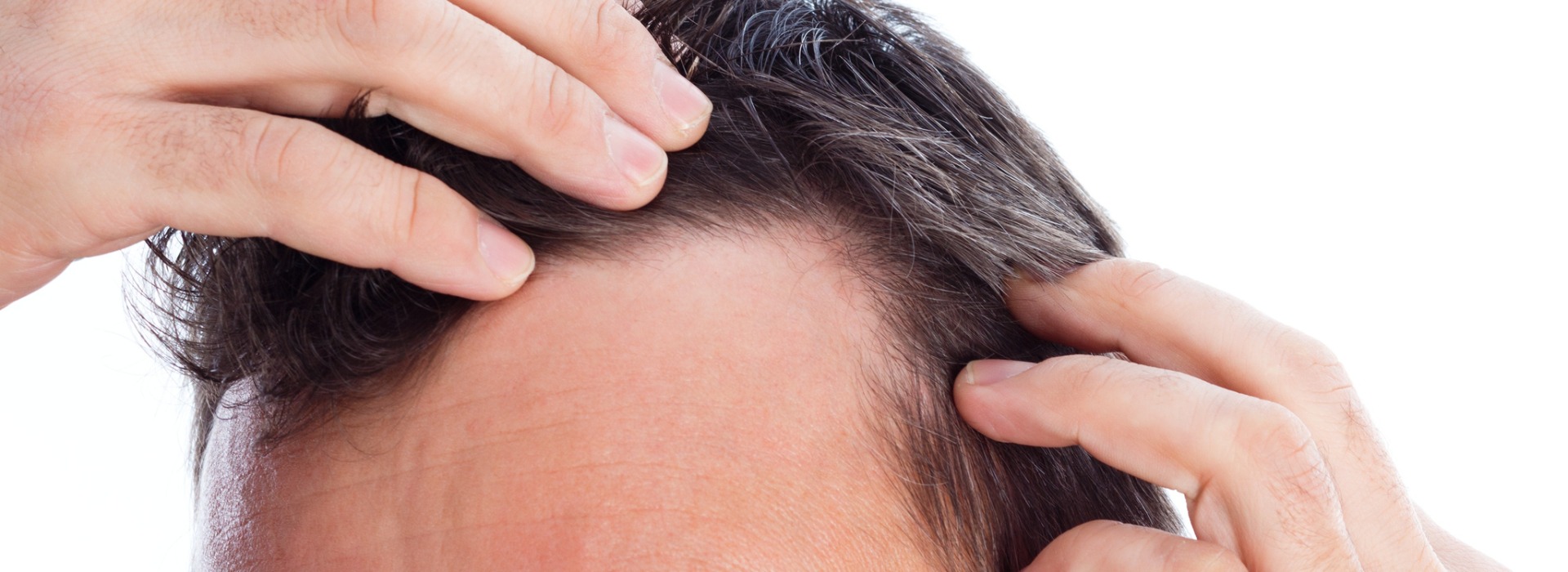 temple-point-hair-transplant-surgery