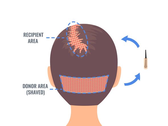 Understanding the Hair Transplant Process in the UK
