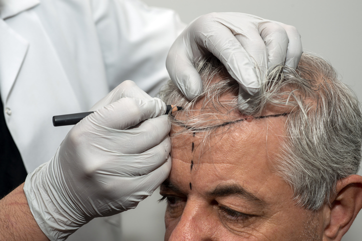 Failed Hair Transplants and Restoring Confidence