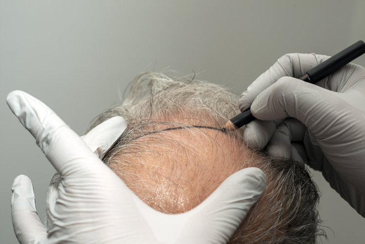 Hair Transplant Before and After: The Role of Hairline Design