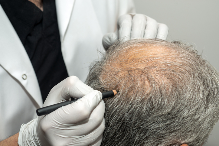 Understanding the Role of Technology in FUE Hair Transplant