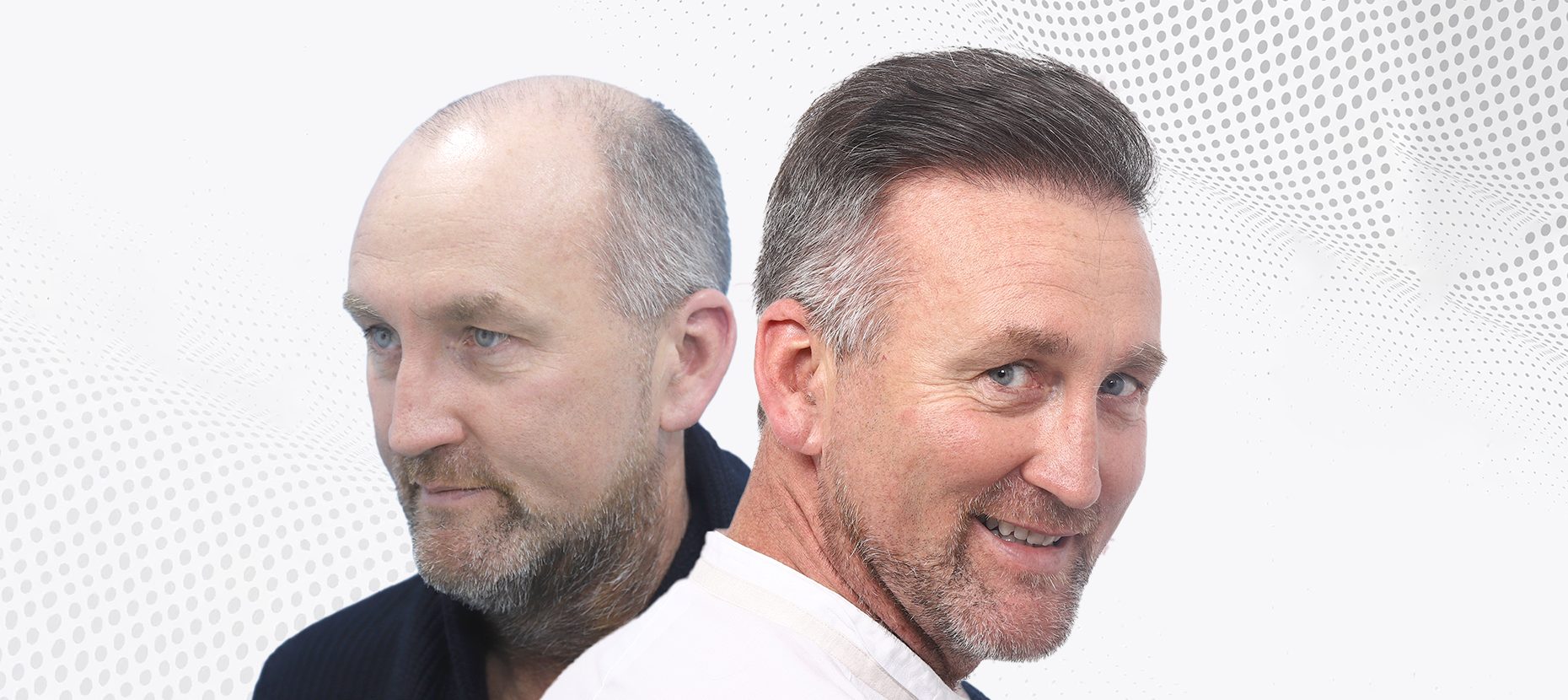 Hair Transplant Before and After: Understanding the Timeline of Results