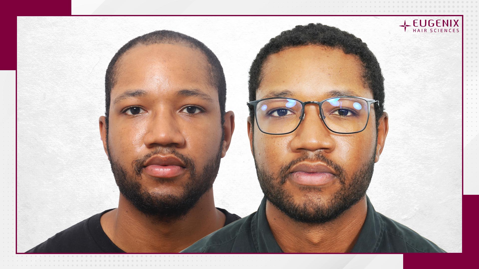 afro-hair-transplant-before-and-after-uk-1
