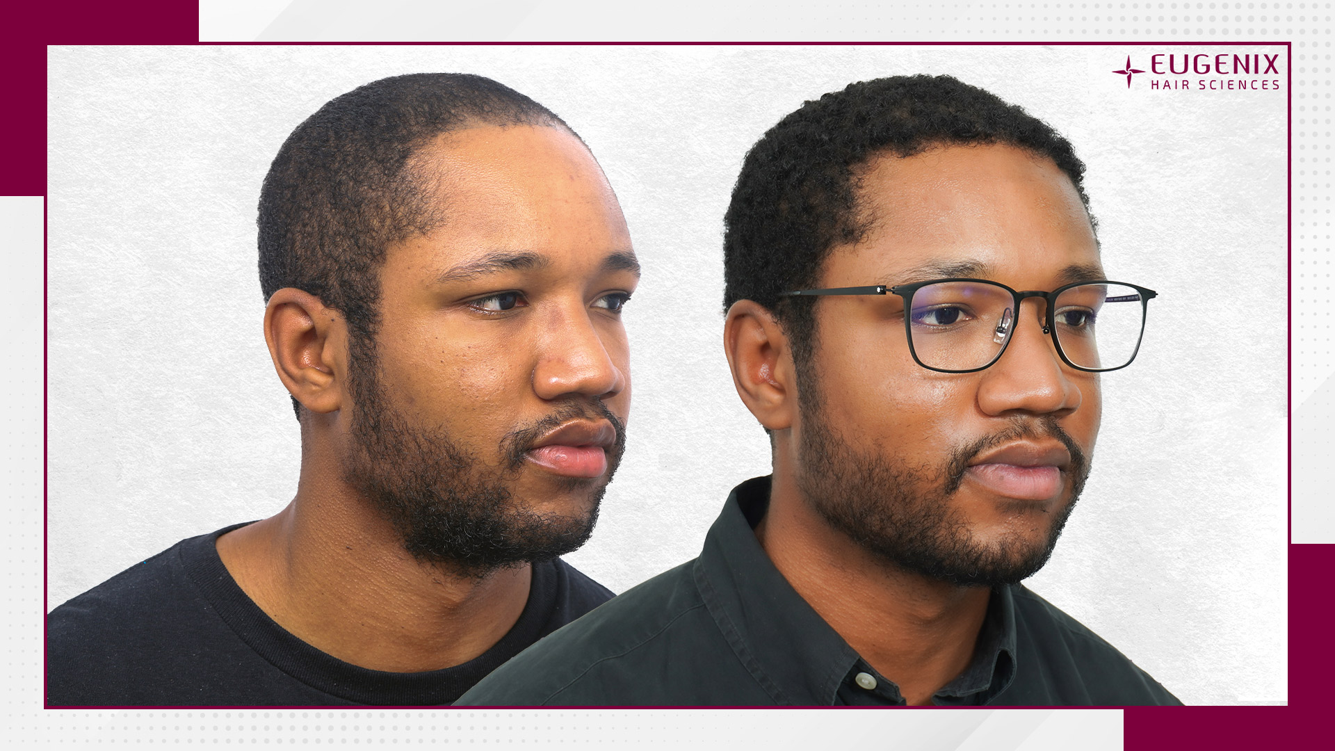 afro-hair-transplant-before-and-after-uk-2