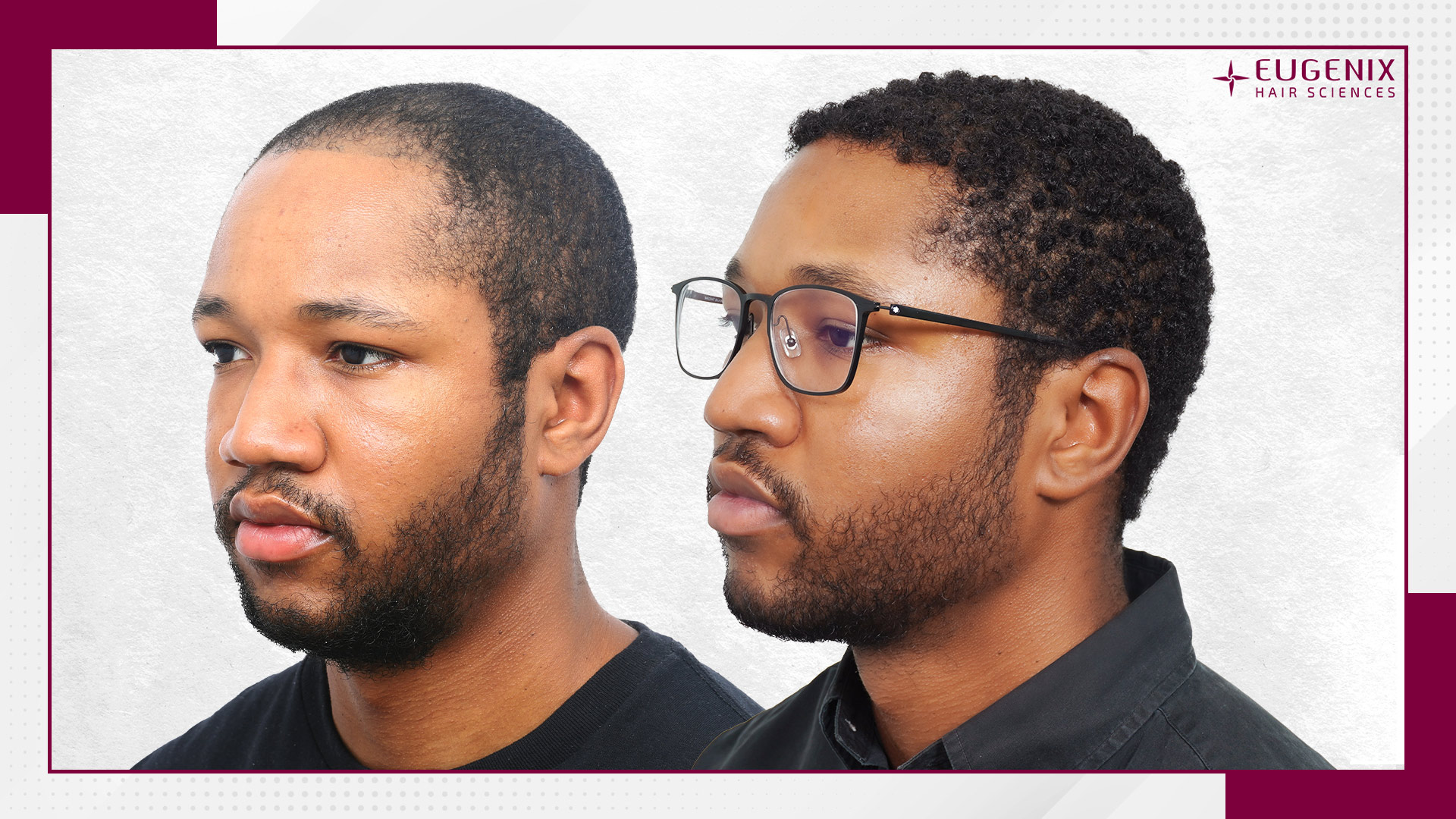 afro-hair-transplant-before-and-after-uk-3