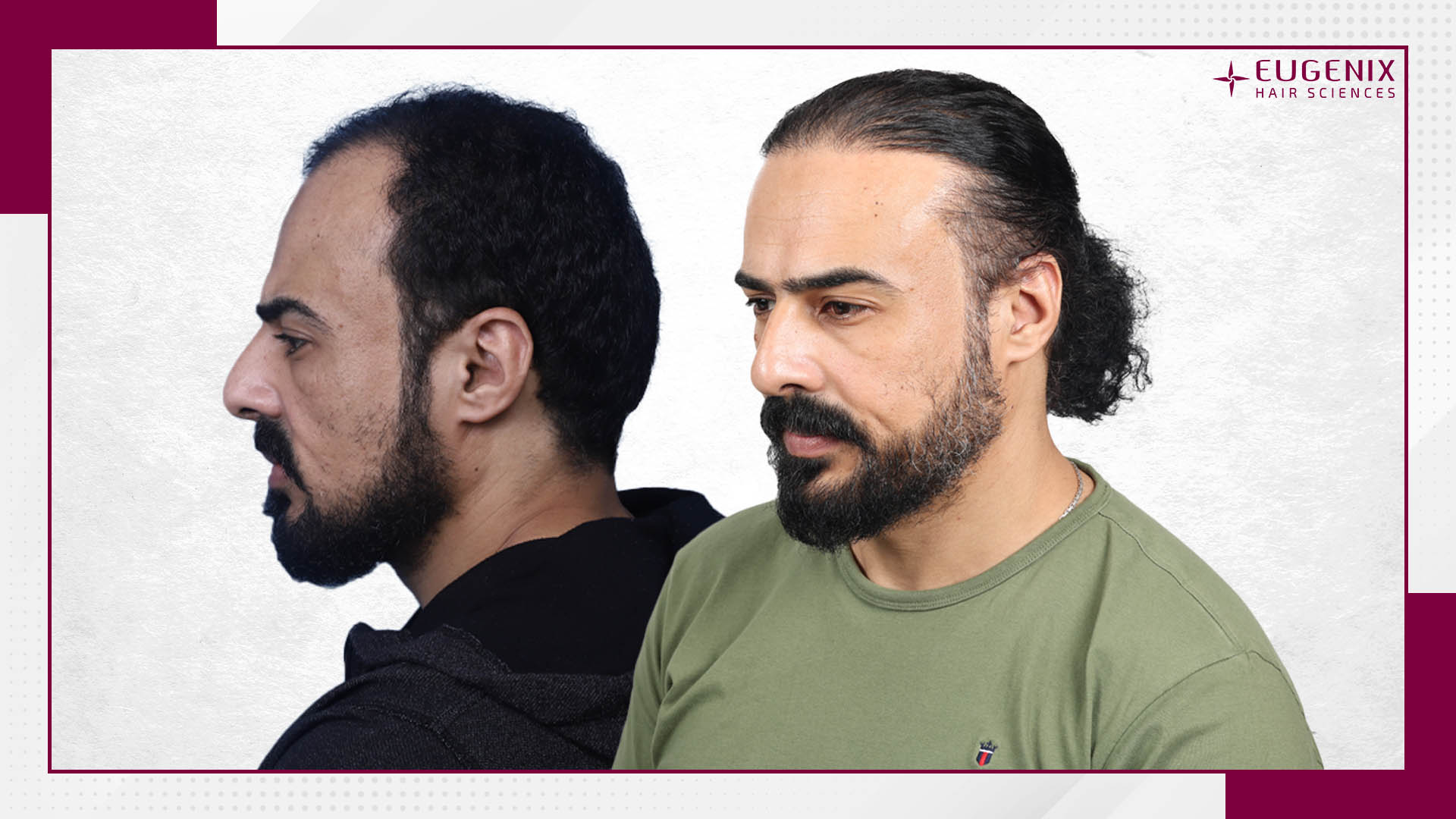 beard-hair-transplant-before-and-after-uk-1