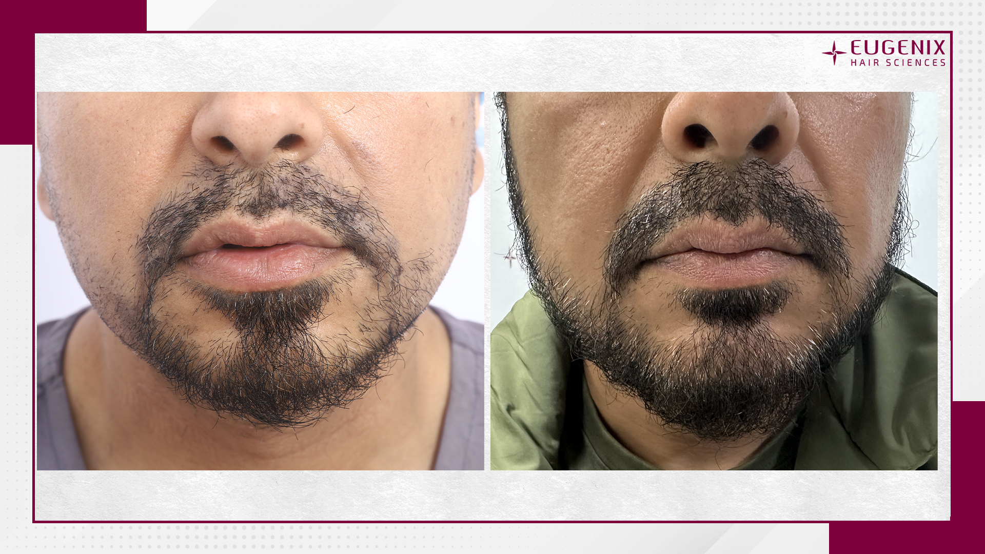 beard-hair-transplant-before-and-after-uk-2