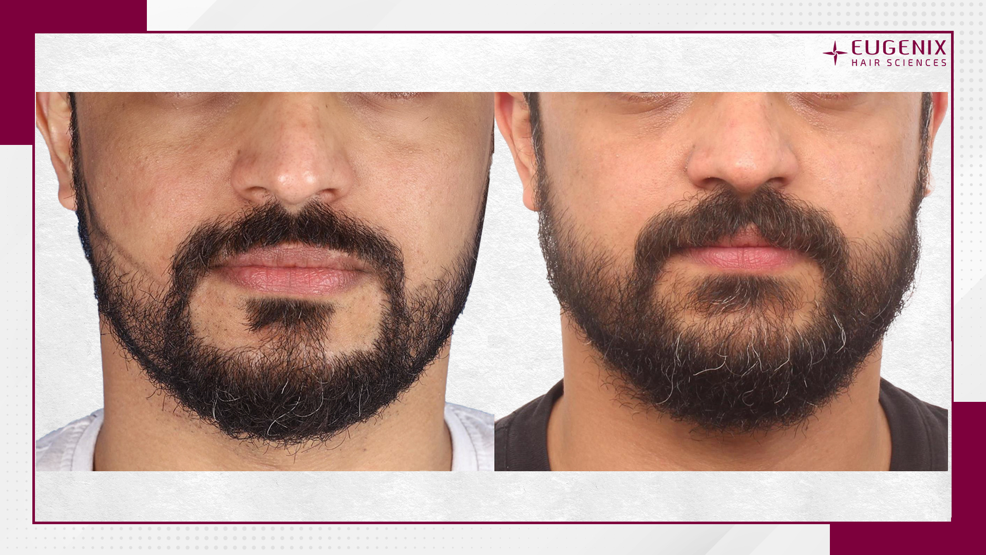 beard-hair-transplant-before-and-after-uk-3