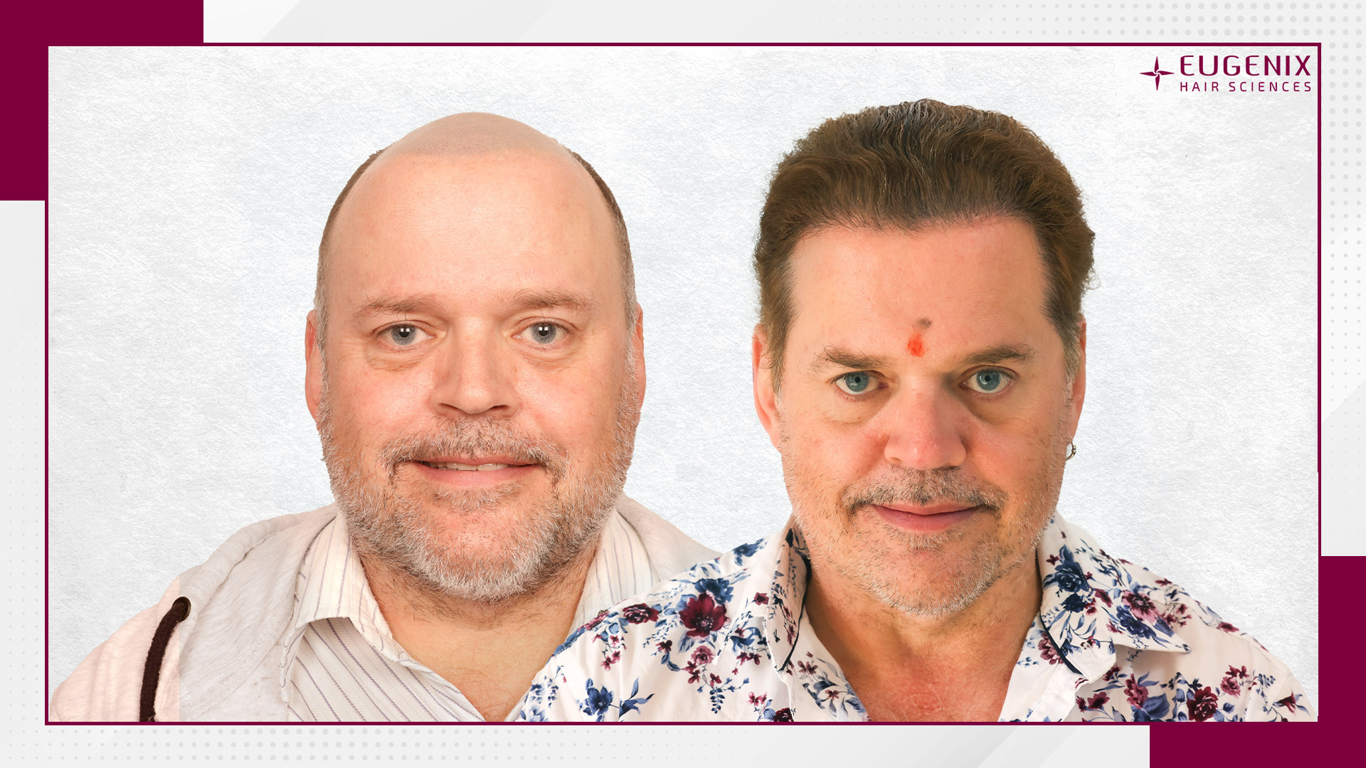 body-hair-transplant-before-and-after-uk-1