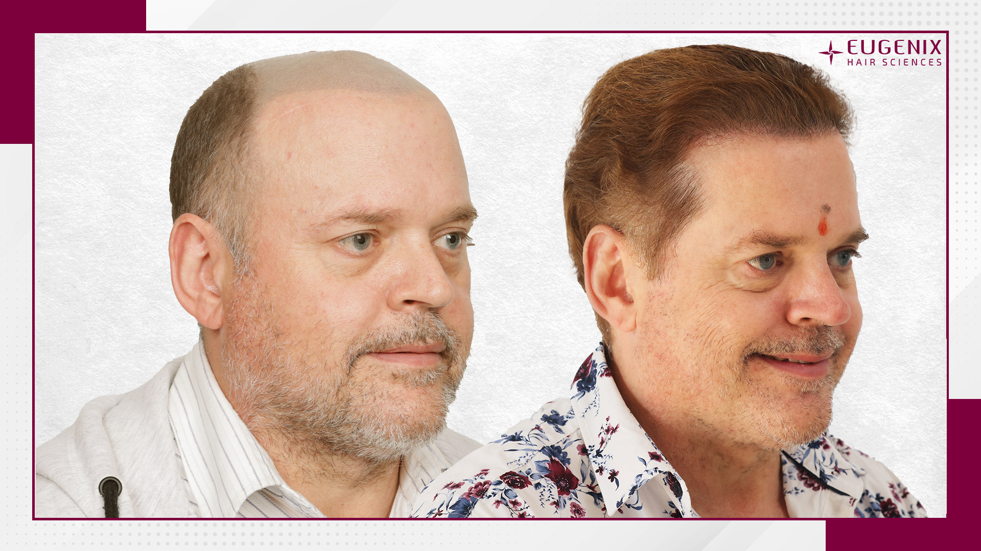 body-hair-transplant-before-and-after-uk-2