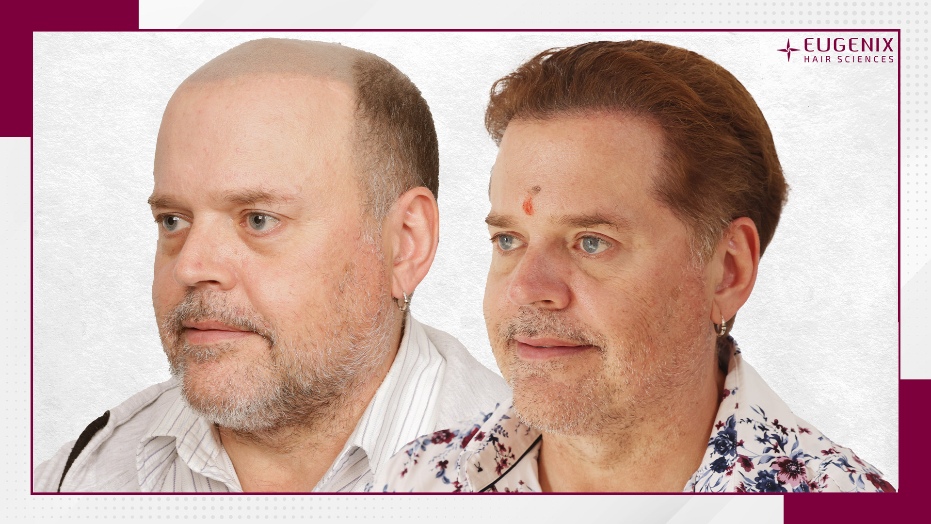body-hair-transplant-before-and-after-uk-3
