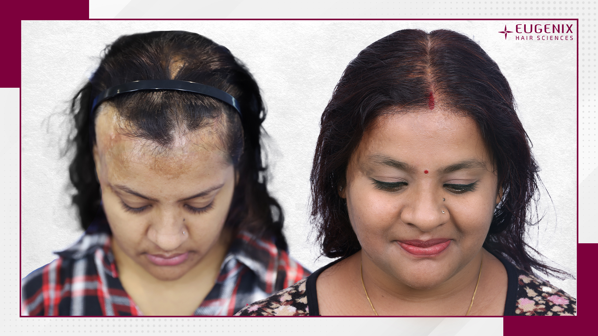 burn-hair-transplant-uk-2