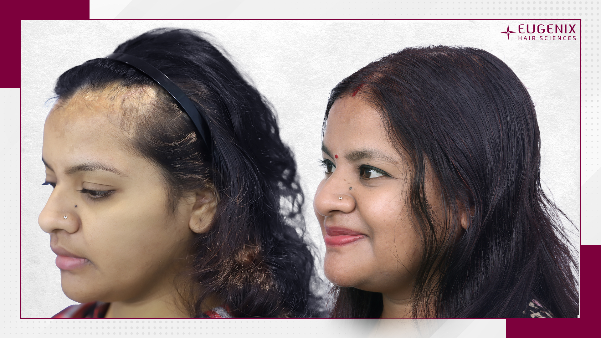 burn-hair-transplant-uk-3