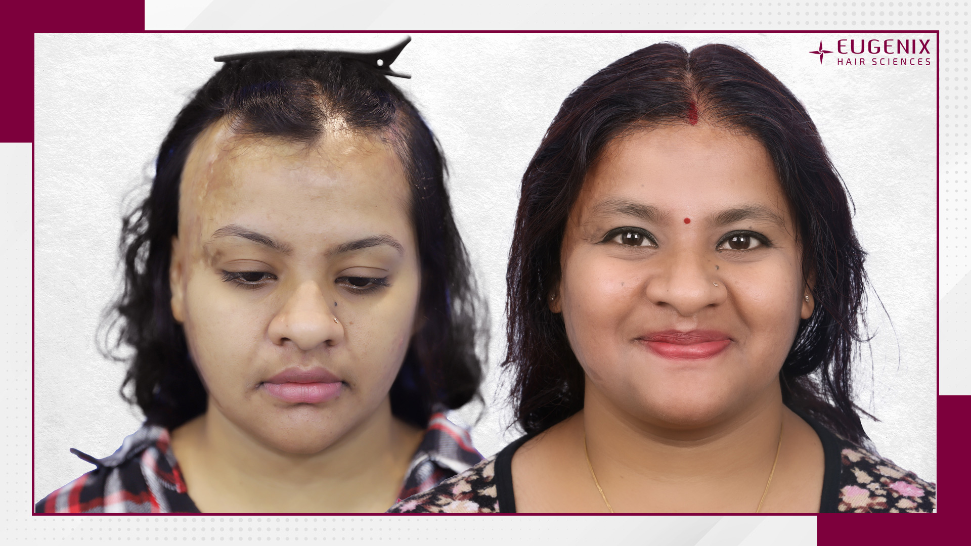 burn-hair-transplant-uk-3