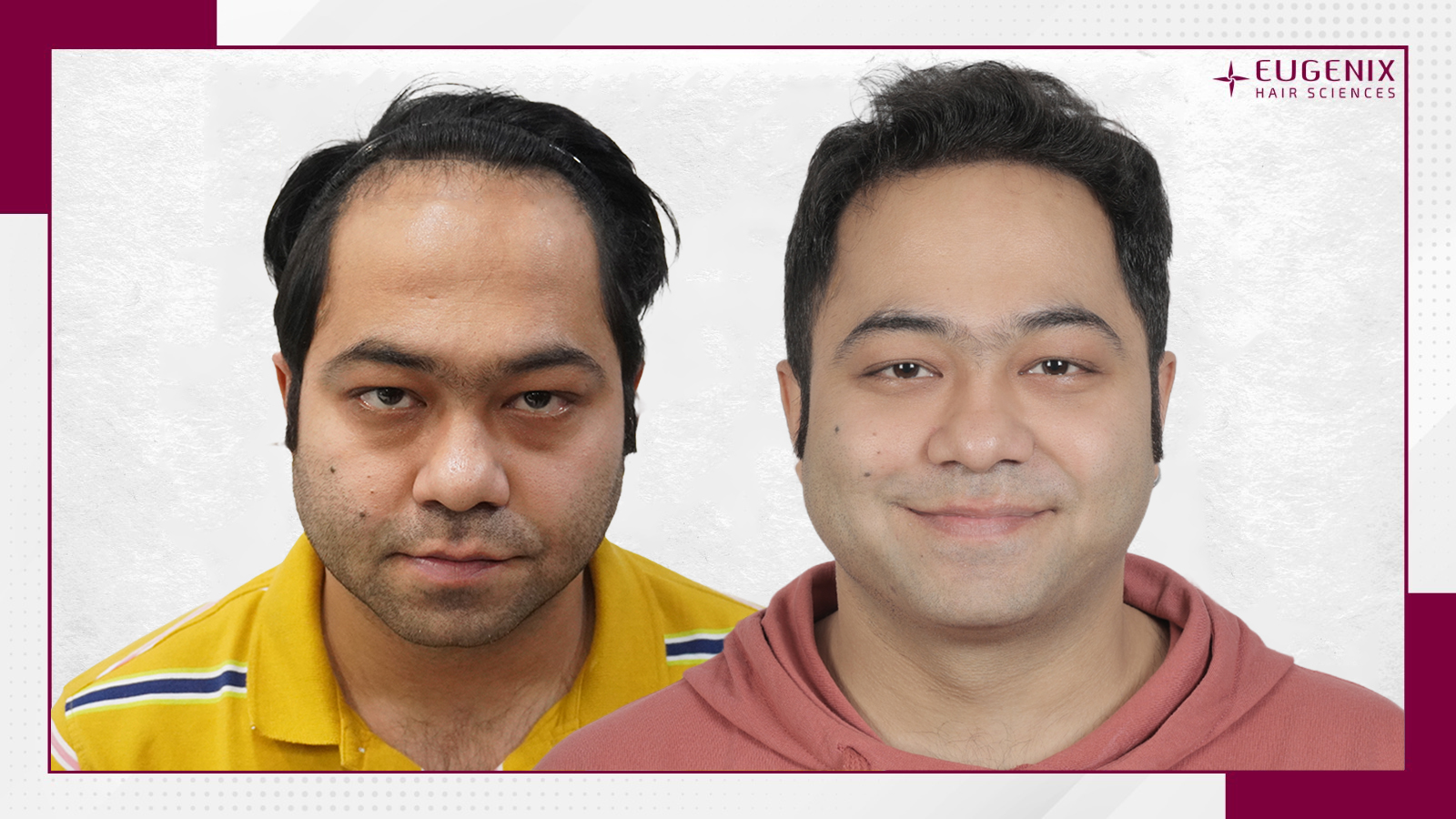 celebrity-hair-transplant-before-and-after-uk-2