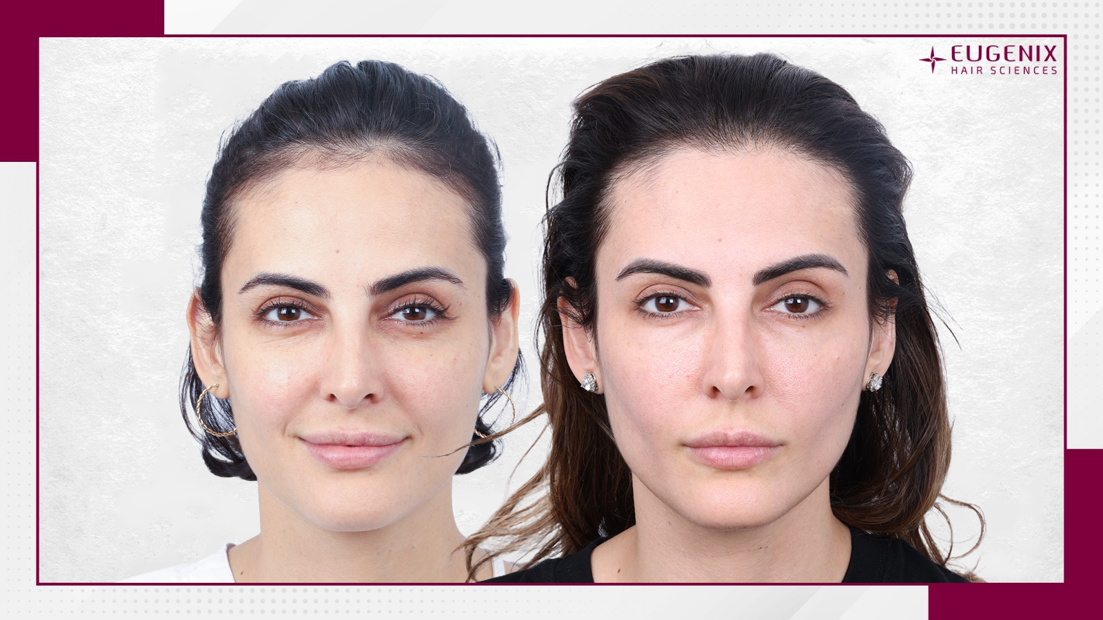 celebrity-hair-transplant-before-and-after-uk-3