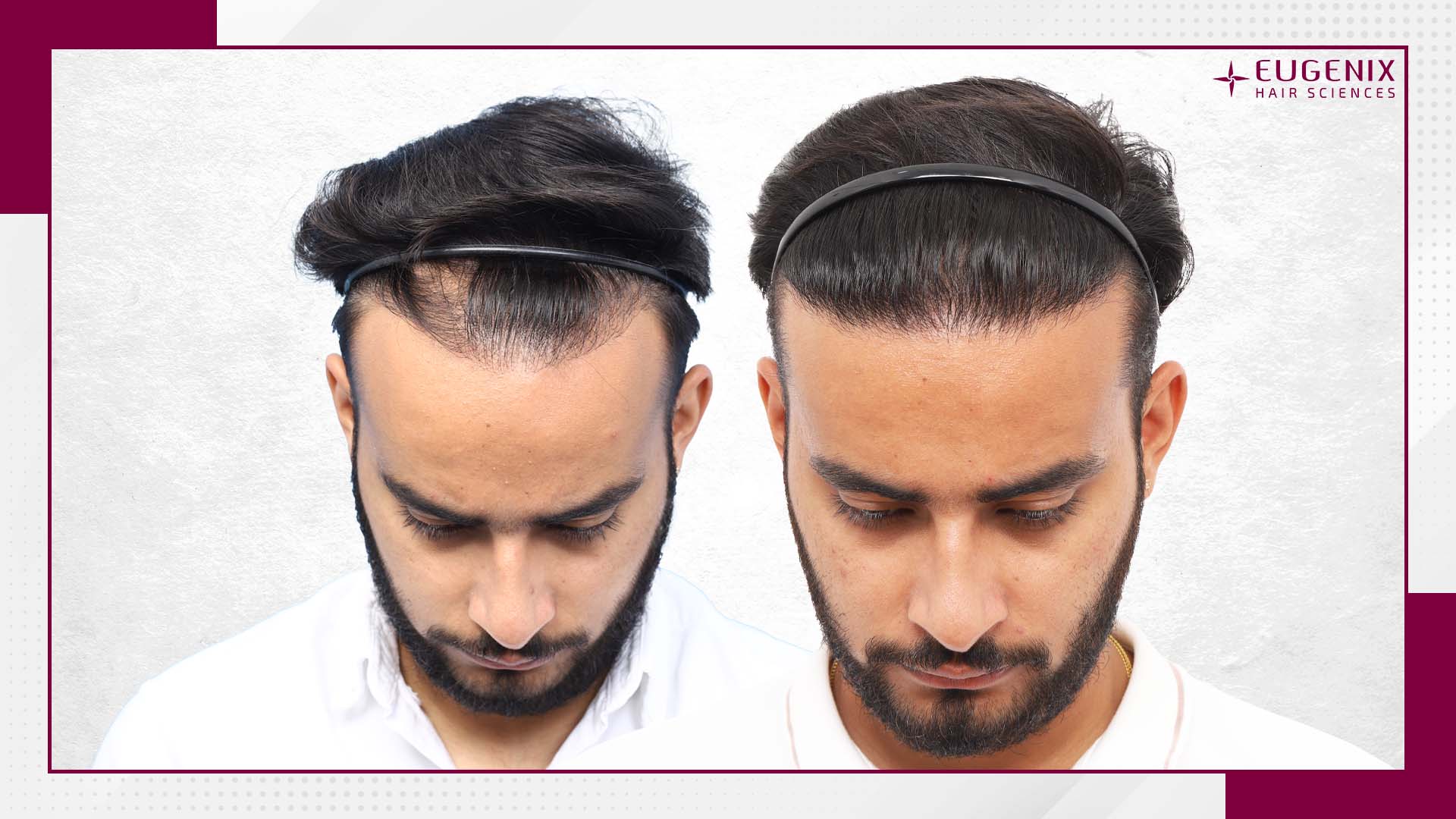 corrective-hair-transplant-1