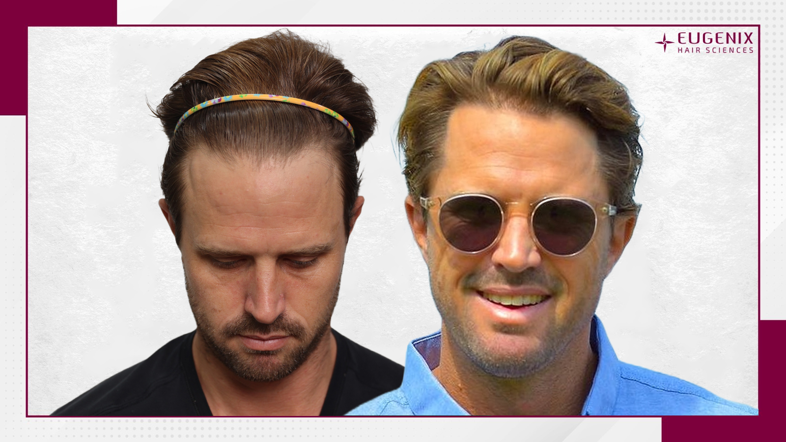 cricketer-hair-transplant-before-and-after-uk-1