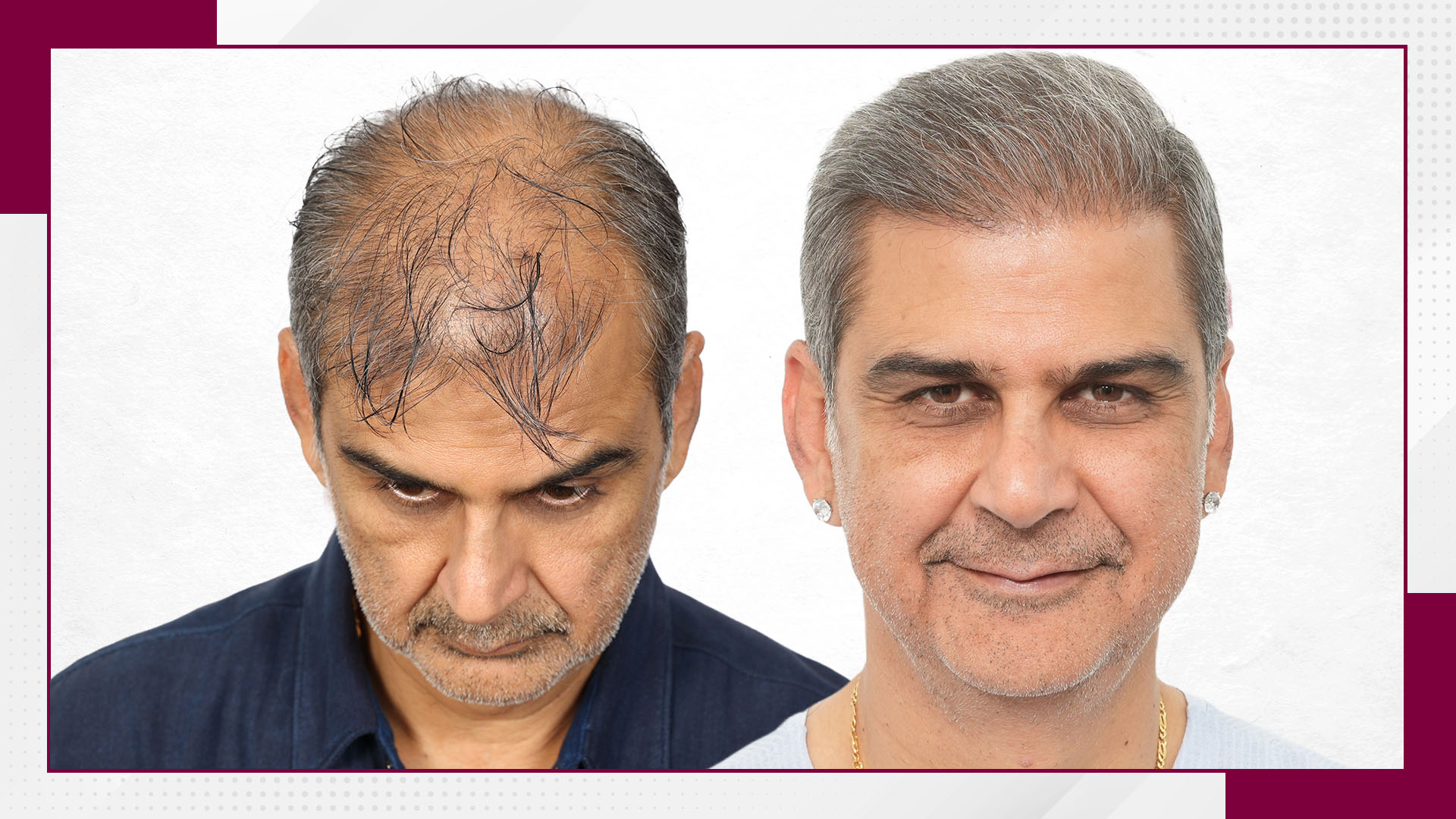 cricketer-hair-transplant-before-and-after-uk-2