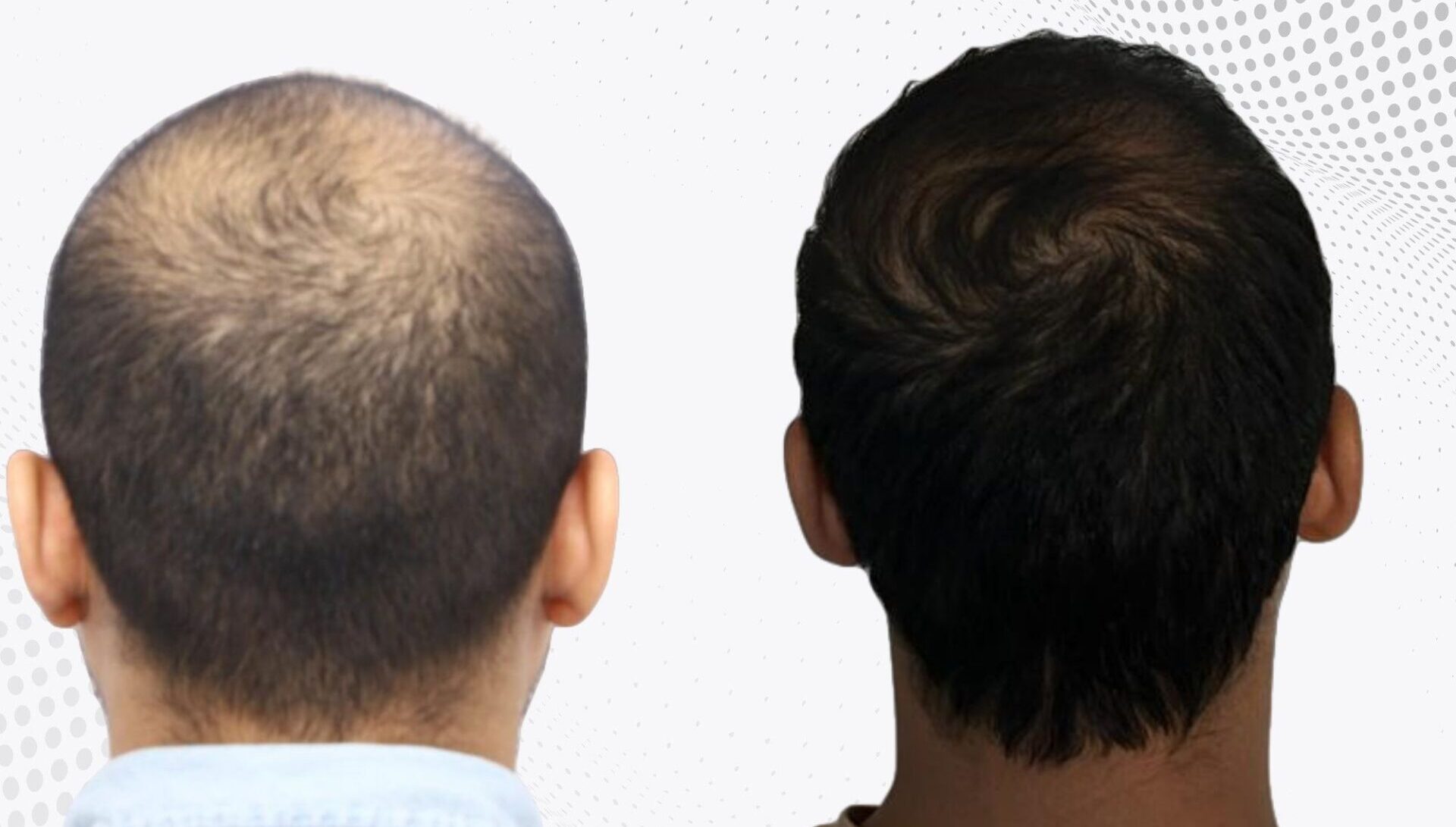 crown-hair-transplant-before-and-after-uk-1