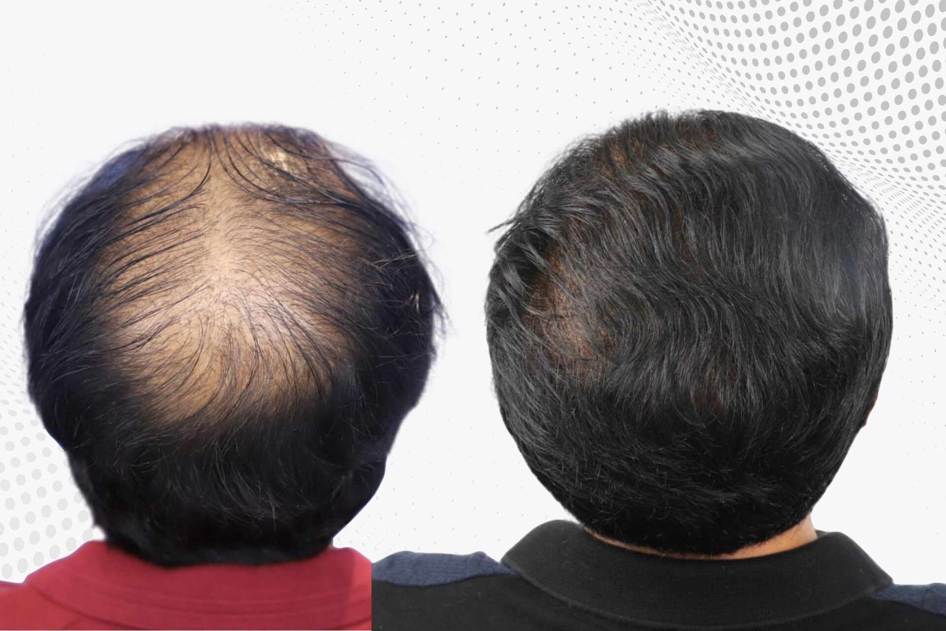 crown-hair-transplant-before-and-after-uk-2
