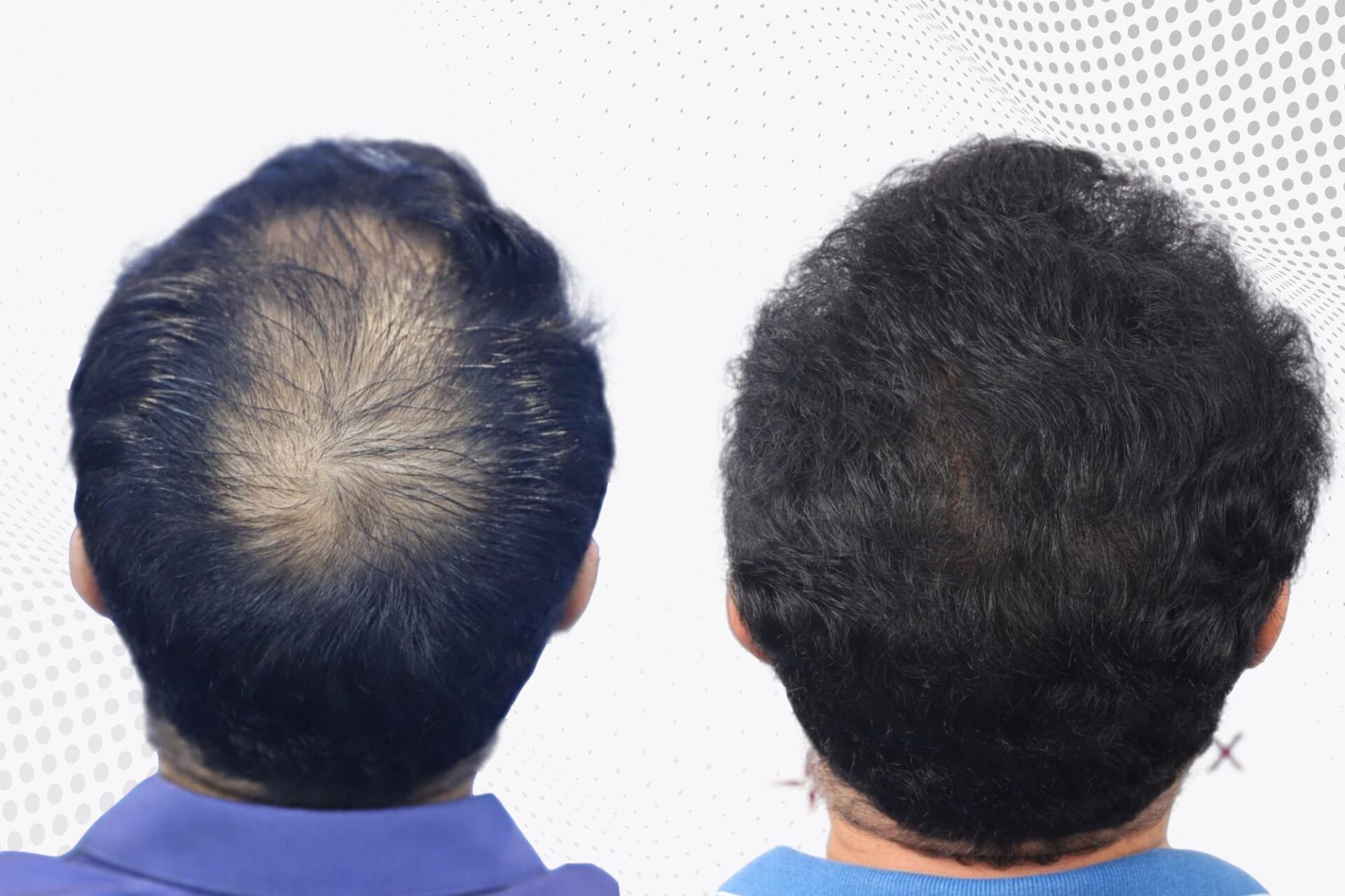 crown-hair-transplant-before-and-after-uk-3