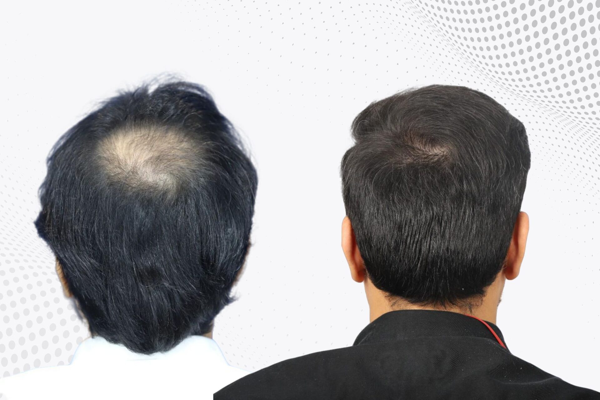 crown-hair-transplant-before-and-after-uk-4